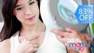 Cauterización Láser de Cabezas de Vena, Lunares o Verrugas