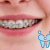 [Imagen:¡Paga Q590 en lugar de Q3,000 por Colocación de Brackets Metálicos (Superiores e Inferiores) + Evaluación y Diagnóstico Clínico + Profilaxis Dental + Fotografías + Blanqueamiento Dental!]