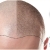 [Imagen:¡Recupera tu Hermosa Cabellera! ¡Paga Q299 en lugar de Q1,500 por 2 Sesiones de Plasma Rico en Plaquetas + Terapia de Luz LED para Alopecia (Calvicie)!]