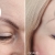 [Imagen:¡Paga Q499 en Vez de Q2,500 Blefaroplastia Sin Cirugía con Tecnología Plasma PlexR para Eliminar Párpados Caídos, Arrugas, Manchas, Lunares y Marcas de Acné + Rejuvenecimiento con Relleno Plasma Gel en Entrecejo, Patas de Gallo o Surco Nasogeniano!]