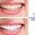 [Imagen:¡Paga $85 en lugar de $325 por 1 Sesión de Blanqueamiento Dental con Sistema Zoom + Consulta Odontológica + Diagnóstico con Cámara Intraoral + Limpieza con Ultrasonido en Western Dental!]