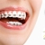 [Imagen:¡Paga $49 en Lugar de $420 por Colocación de Brackets Metálicos + Evaluación y Diagnóstico Clínico + Fotografías y Modelo de Estudio + 1 Consulta de Control + 1 Limpieza Dental!]