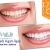 [Imagen:¡Paga $85 en vez de $325 por 1 Sesión de Blanqueamiento Dental con Sistema Zoom + Consulta Odontológica + Diagnóstico con Cámara Intraoral + Limpieza con Ultrasonido en la lujosa sala VIP de Western Dental San Benito!]