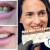 [Imagen:¡Paga $60 en Lugar de $125 por Carilla Dental de Cerómero + Limpieza Dental con Ultrasonido!]