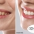 [Imagen:¡Paga Q395 en Lugar de Q1,520 por Blanqueamiento Dental Químico con Luz LED + Desmanchado con Profilaxis + Limpieza con Ultrasonido + Evaluación Completa!]