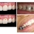 [Imagen:¡Paga $25 en Lugar de $210 por Reconstrucción Mínimamente Invasiva de 4 Dientes Frontales + Consulta General + Limpieza Dental + Aplicación Tópica de Flúor + Férula + Estuche!]