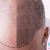 [Imagen:¡Libérate YA de la Calvicie! ¡Paga Q699 en vez de Q3,125 por Paquete para Alopecia que incluye: 1 Sesión de Plasma Rico en Plaquetas + 2 Sesiones de Carboxiterapia + 1 Sesión de Luz LED roja en Clínica Dermatológica Kalyana!]