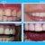 [Imagen:¡Paga $25 en lugar de $75 por Reconstrucción De Dientes Frontales que Incluye: 2 Carillas Dentales de Resina Nano Híbrida de Porcelana y Zirconio + Limpieza Dental con Ultrasonido + Aplicación de Flúor!]