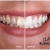 [Imagen:¡Paga Q130 en Lugar de Q285 por 3 Lápices Blanqueadores de Dientes!]