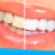 [Imagen:¡Paga $79 en vez de $325 por 1 Sesión de Blanqueamiento Dental EXTREMO con sistema ZOOM + Limpieza con Ultrasonido!]