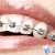 [Imagen:¡Paga $85 en lugar de $450 por Colocación de Mini-Brackets Metálicos + Evaluación y Diagnóstico de Ortodoncia + Diagnóstico Odontológico General + Profilaxis Dental!]