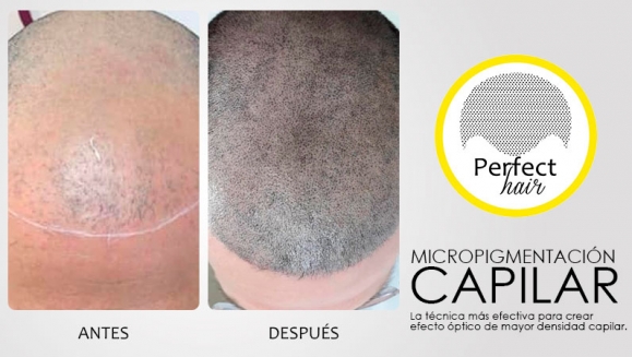 [Imagen:¡Paga $150 en Lugar de $300 por 2 Sesiones de Micropigmentación Capilar!]