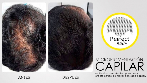 [Imagen:¡Paga $150 en Lugar de $300 por 2 Sesiones de Micropigmentación Capilar!]