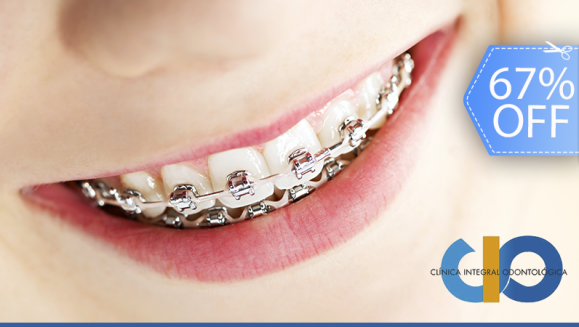 [Imagen:¡Paga Q599 en Lugar de Q1,800 por Paquete de Ortodoncia que Incluye: Colocación de Brackets Metálicos (Superiores e Inferiores) + Evaluación y Diagnóstico Clínico + Limpieza Completa + Fotografías y Modelo de Estudio!]