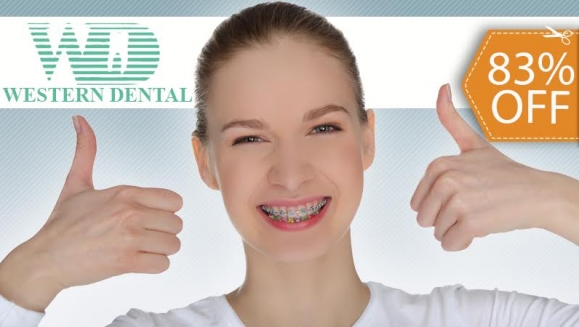 [Imagen:¡Paga $99 en lugar de $575 por Colocación de Brackets Metálicos para Alineación de Dientes!]