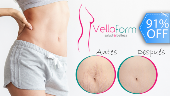 [Imagen:¡Paga Q399 en vez de Q4,220 por 22 Tratamientos para Disminuir Estrías: 4 Mesoterapias Tópicas + 2 Peelings Químicos + 2 Microdermoabrasiones + 2 Radiofrecuencias Infrarrojas + 2 Mascarillas Regeneradoras Celulares + 4 Corrientes Galvánicas y Más!]