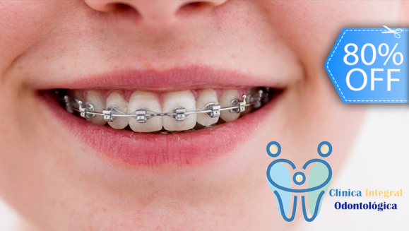 [Imagen:¡Paga Q590 en lugar de Q3,000 por Colocación de Brackets Metálicos (Superiores e Inferiores) + Evaluación y Diagnóstico Clínico + Profilaxis Dental + Fotografías + Blanqueamiento Dental!]