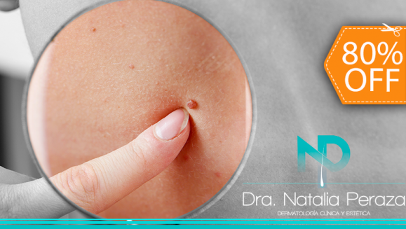[Imagen:¡Paga $20 en Lugar de $100 por Eliminación de hasta 20 Verrugas o Cabezas de Vena en Cuello, Axilas o Rostro + Consulta Dermatológica!]