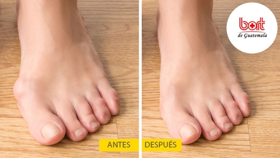 [Imagen:¡Paga Q99 en lugar de Q200 por Férula Hallux Valgus para Corrección de Juanetes!]