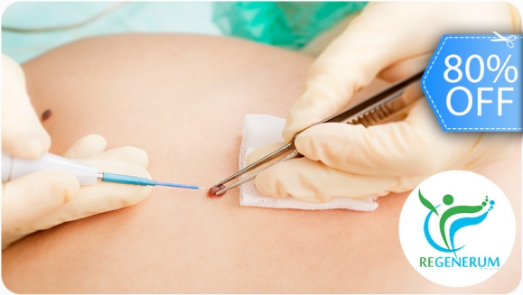 [Imagen:¡Paga Q99 en lugar de Q500 por Cauterización Láser de Lunares, Verrugas, Cabezas de Vena o Mezquinos + Evaluación Médica!]