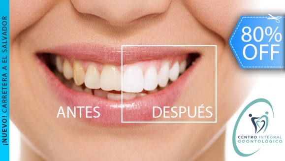[Imagen:¡Paga Q450 en lugar de Q2,200 por Blanqueamiento Dental con Luz LED + Limpieza con Ultrasonido + Pulido con Profijet + Kit de Mantenimiento en Casa + Evaluación con Cámara Intraoral!]