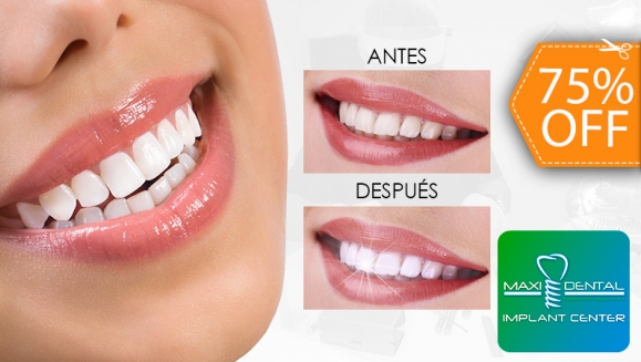 [Imagen:¡Paga $65 en Lugar de $265 por Blanqueamiento Dental con Lámpara UV + Limpieza con Ultrasonido + Aplicación de Gel Desensibilizante!]