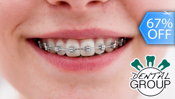 [Imagen:¡Paga Q599 en lugar de Q1,800 por Colocación de Mini-Brackets (Superiores e Inferiores) + Evaluación y Diagnóstico Clínico + Profilaxis Dental + Fotografías y Modelo de Estudio!]