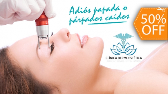 [Imagen:¡Paga $150 en Lugar de $300 por 2 Sesiones de Derma-Age (Blefaroplastía Láser sin Cirugía) para Eliminar Párpados Caídos o Papada!]