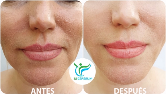 [Imagen:¡Paga Q999 en lugar de Q4,500 por Lifting de Párpados (Superiores o Inferiores) o del Labio Superior (Código de Barras) con Plasma Láser!]