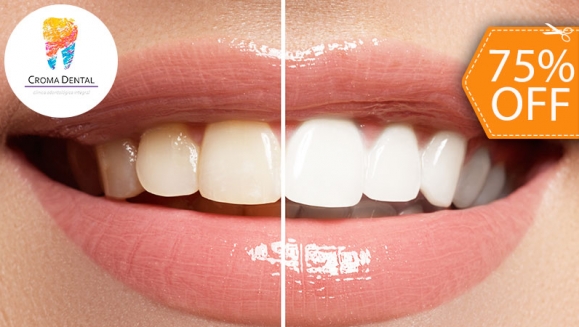 [Imagen:¡Paga $50 en Lugar de $200 por Blanqueamiento Dental Químico con Luz LED + Limpieza Profunda con Ultrasonido (Destartraje) + Consulta Odontológica!]