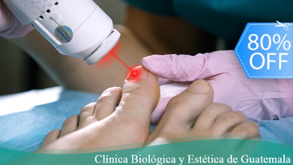 [Imagen:¡Paga Q199 en lugar de Q1,000 por Sesión Láser para Tratar los Hongos en las 10 Uñas de Manos o Pies + Pedicure o Manicure Clínico (Limpieza de Canales, Exfoliación, Recorte y Limado de Uñas, Gel Antiinflamatorio y Más) + Evaluación Médica!]