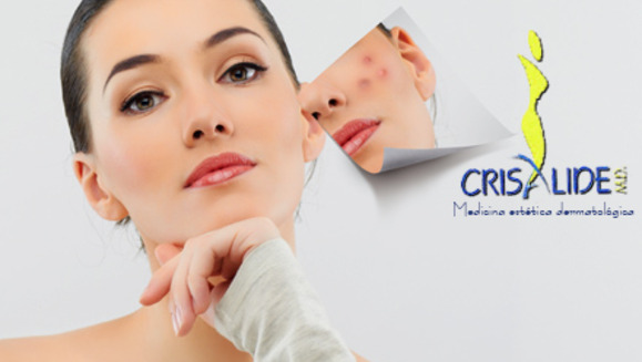 [Imagen:¡Paga Q249 en lugar de Q999 por un peeling facial personalizado según tu tipo de piel + mascarilla hidratante + limpieza facial + evaluación médica dermatológica + gel (para aplicar en casa) de aloe vera, manzanilla y romero en Crisalide!]