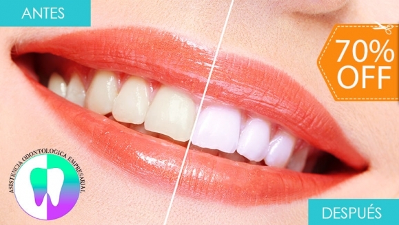 [Imagen:¡Paga $59 en Lugar de $195 por Blanqueamiento Dental Químico con Luz LED + Limpieza Manual + Profilaxis (Pulido Dental) + Consulta Odontológica!]