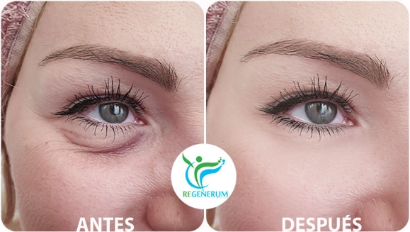 [Imagen:¡Paga Q999 en lugar de Q4,500 por Lifting de Párpados (Superiores o Inferiores) o de Labio Superior (Código de Barras) con Plasma Láser!]
