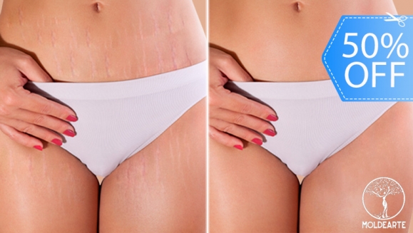 [Imagen:¡Paga Q375 en Lugar de Q750 por Camuflaje de Estrías (Maquillaje Permanente) en Área a Elección entre Glúteos, Brazos o Abdomen!]