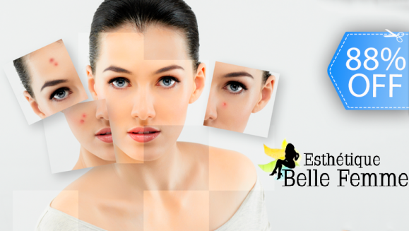 [Imagen:¡Paga Q99 en lugar de Q800 por Microdermoabrasión o Peeling Personalizado + Facial de Limpieza Profunda con Exfoliación + Alta Frecuencia + Energía Galvánica + Hidratación + Extracción de Puntos Negros + Vaporización  y Aromaterapia!]