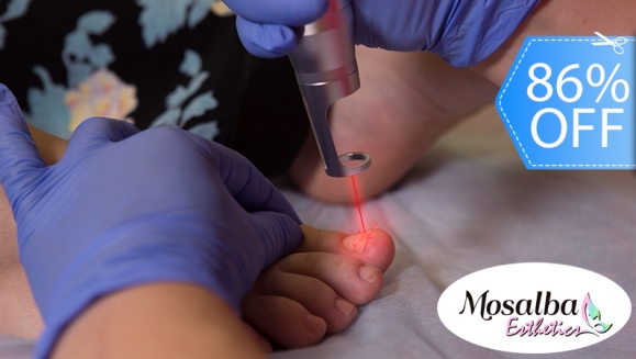 [Imagen:¡Paga Q250 en Lugar de Q1,800 por 3 Sesiones Láser para Eliminar Hongos en hasta 10 Uñas de Manos o Pies + Diagnóstico Profesional + Aplicación de Crema Antimicótica!]