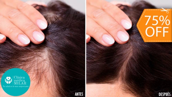[Imagen:¡Paga $75 en Lugar de $300 por 3 Sesiones de Mesoterapia y Altafrecuencia Capilar para Estimular el Crecimiento del Cabello y Evitar La Calvicie!]