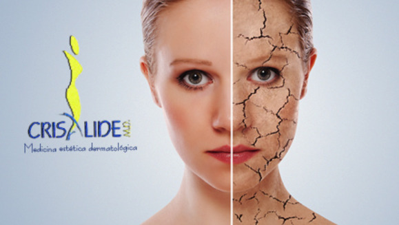 [Imagen:¡Paga Q275 en lugar de Q1425 por 4 sesiones de peeling químico facial que incluye: 4 aplicaciones de ácido glicólico + 4 altafrecuencias + 4 hidrataciones y protección solar + 4 mascarillas anti-envejecimiento o anti-acné en Crisalide!]
