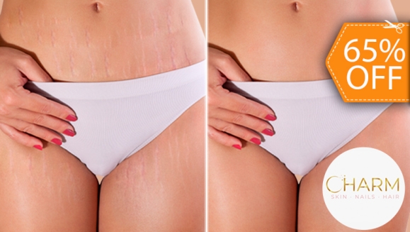 [Imagen:¡Paga $210 en Vez de $600 por 4 Sesiones de Camuflaje de Estrías con: 3 Sesiones de Micropigmentación + 1 Sesión de Ácido Hialurónico con Dermógrafo + 1 Microdermoabrasión con Punta de Diamante + 1 Mascarilla de Colágeno + 1 Altafrecuencia y Más!]