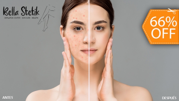 [Imagen:¡Paga $22 en Lugar de $65 por Facial Antiacné con: Aplicación de Láser + Peeling + Extracción de Puntos Negros y Comedones + Mascarilla Bioacné + Serum Hidratante + Limpieza + Exfoliación + Solución Antiacné y Más!]