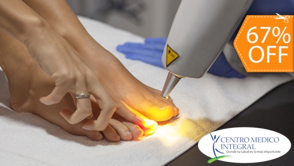 [Imagen:¡Paga $20 en Lugar de $60 por 3 Sesiones de Láser para Eliminar Hongos de Las Uñas!]