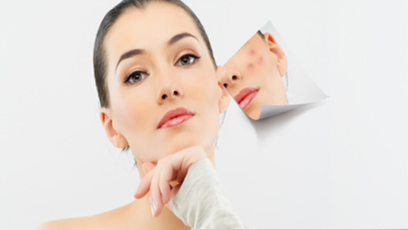 [Imagen:¡Paga Q250 en lugar de Q1200 por Paquete de 3 Microdermoabrasiones con punta de diamante  que incluyen limpieza facial, alta frecuencia y velo de colágeno en Clínica Biológica y Estética de Guatemala!]