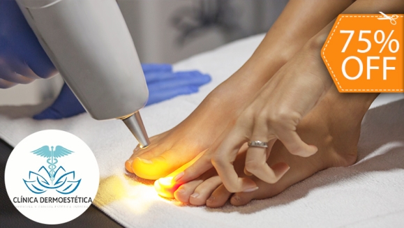 [Imagen:¡Paga $10 en Lugar de $40 por 1 Sesión Láser para 2 Uñas con Hongo + Evaluación Médica!]