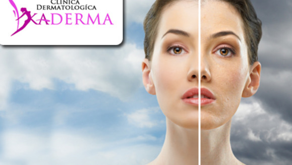 [Imagen:¡Paga $35 en lugar de $125 por 2 sesiones de microdermoabrasión con punta de diamante + diagnostico médico de la piel en Clínica Dermatológica Kaderma!]
