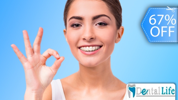 [Imagen:¡Paga Q599 en Lugar de Q1,800 por Colocación de Brackets Metálicos (Superiores e Inferiores) + Evaluación y Diagnóstico Clínico + Profilaxis Dental + Fotografías Dentales!]