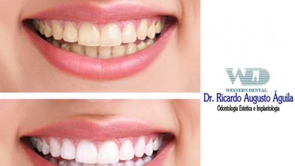 [Imagen:¡Paga $85 en lugar de $325 por 1 Sesión de Blanqueamiento Dental con Sistema Zoom + Consulta Odontológica + Diagnóstico con Cámara Intraoral + Limpieza con Ultrasonido en Western Dental!]