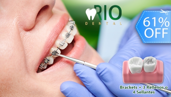 [Imagen:¡Paga Q599 en Vez de Q1,550 por Colocación de Brackets Metálicos + 3 Rellenos o 4 Sellantes + Limpieza Profunda con Ultrasonido + Pulido Dental con Profijet + Evaluación Clínica + Fotografías Dentales + Aplicación de Flúor + Plan de Tratamiento!]