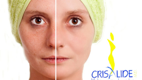 [Imagen:¡Paga Q135 en lugar de Q800 por Paquete Facial que incluye: 1 Peeling personalizado + 1 Microdermoabrasión con Puntas de Diamante + 2 Altafrecuencias + 2 Hidrataciones + 2 Mascarillas anti-aging o anti-acné en Crisalide!]