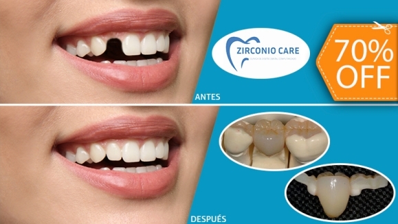 [Imagen:¡Paga $80 en Lugar de $265 por 1 Pieza Dental de Zirconio, Resina y Porcelana (Sin Metales) + Limpieza Dental con Ultrasonido + 2 Sellantes + Evaluación de Cordales + Certificado de $10!]